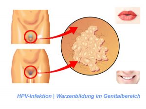 Wszystko, co powinieneś wiedzieć o HPV