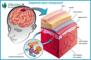 Zapalenie opon mózgowych: co to i jak chronić zdrowie