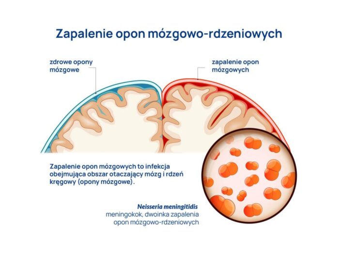 Zapalenie opon mózgowych w Anglii: zdrowie, profilaktyka i NHS